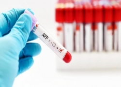 Chỉ số xét nghiệm máu phát hiện ung thư: Đánh giá, quan trọng và ứng dụng trong y học hiện đại