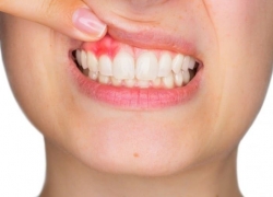 Các bệnh về răng miệng thường gặp